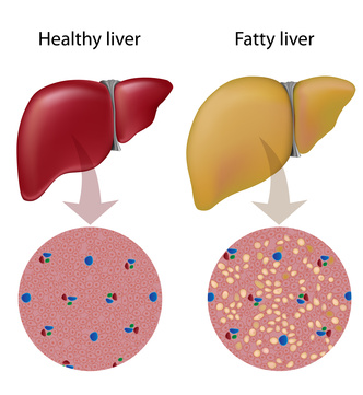 PCOS and Fatty Liver